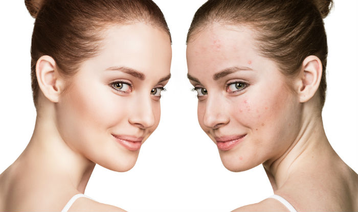 How to Eat When Dealing with Acne: Which Foods Are Most Likely to Cause Acne?